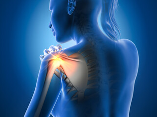 Painful shoulder joints. Frozen shoulder, impingement. 3d illustration - obrazy, fototapety, plakaty