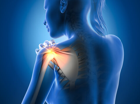 Painful shoulder joints. Frozen shoulder, impingement. 3d illustration