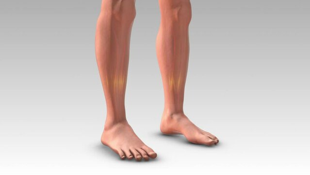 The medical condition of pitting edema