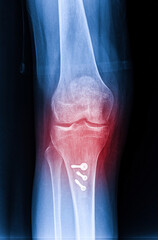 X-ray Knee Joint Fracture proximal tibia and Post fix fracture proximal tibia with plate and...