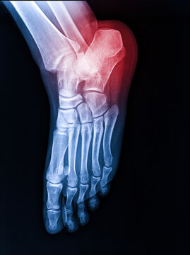 X-rays of the human foot, highlighted in red