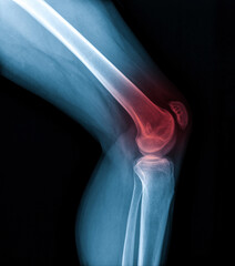 Knee joint x-ray (AP and LATERAL) view fracture and displacement of the patella bone or knee cap,...