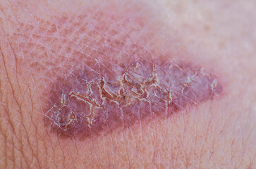 wound red burn with cracks and peeling close-up on a person's hand