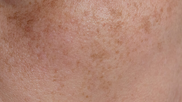 Piel del rostro con manchas y pecas.