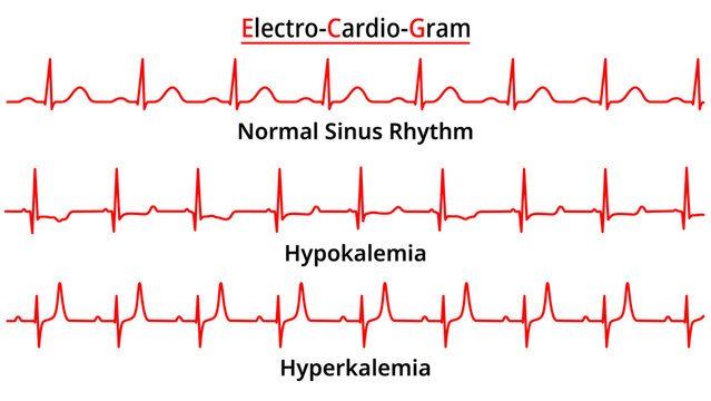 Set of ECG Common Abnormalities - Hyperkalemia - Hypokalemia - Electrocardiogram Vector Medical Illustration