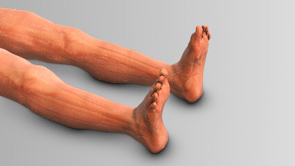 Lower limb edema or swollen legs - obrazy, fototapety, plakaty
