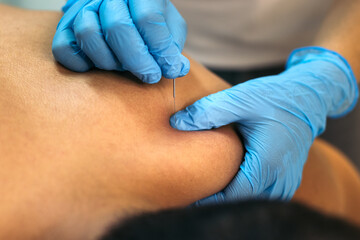 Physiotherapy Clinic: Dry Needling