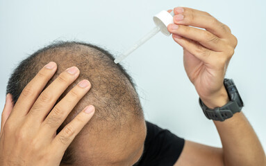 Cropped shot view of Asian baldness man using a dropper for dropping Minoxidil to his scalp.