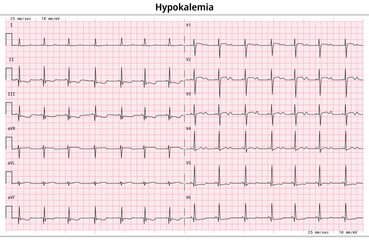 ECG Hypokalemia - Hypokalaemia - 12 Lead ECG Common Case - 3 Sec/lead - Electrocardiogram Vector Medical Illustration