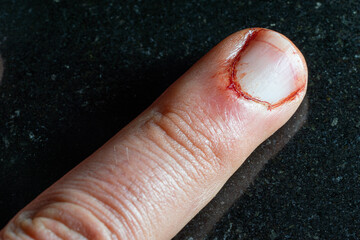 index finger of human hand injured with blood residue