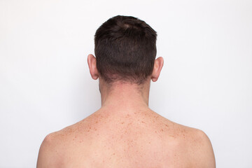 Age or pigment spots, moles and freckles on the back and shoulders of an adult man, close-up. Pigmentation on the body and skin. Liver spots, lentigo, sun spots. Cosmetology and beauty concept - obrazy, fototapety, plakaty