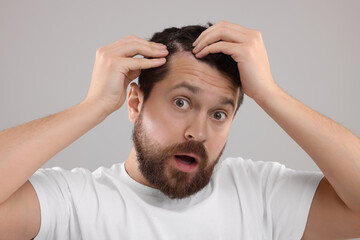 Emotional man with dandruff in his dark hair on light gray background