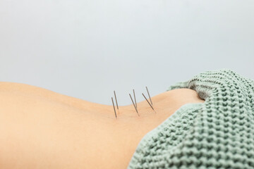 Close-up View of Acupuncture Needles on Back