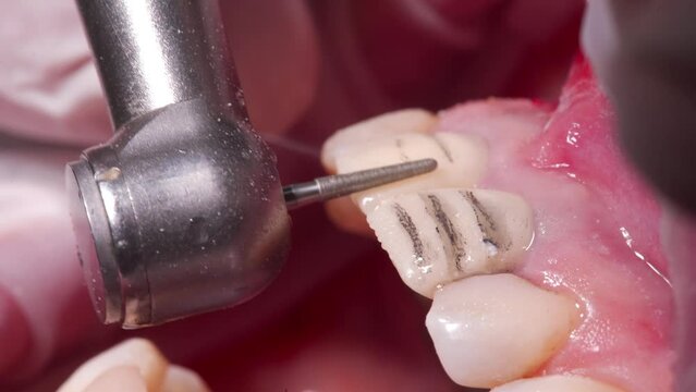 Close-up shot of removing partly teeth enamel by dental bur. Dentist preparing woman's teeth for installing ceramic veneers and crowns using the dental bur. Dentistry, prosthetics concept.