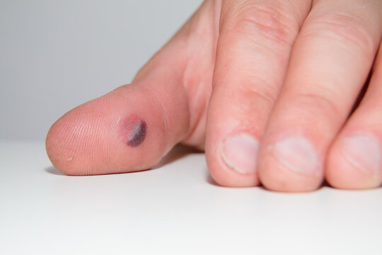 Blood blister under the thumb skin. Caucasian young man finger on white background