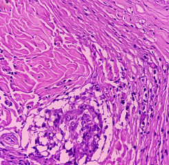 Thyroid cancer: Microscopic image of Follicular neoplasm. Malignant neoplasm of atypical thyroid...