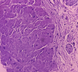 Prostatic Tissue (biopsy): Sections show show fatty tissue, neural tissue and muscle tissue....