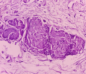 Obraz premium Prostatic Tissue (biopsy): Sections show show fatty tissue, neural tissue and muscle tissue. Prostate cancer diagnosis.