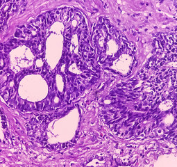 Prostatic chips (TURP): Adenocarcinoma. Sections show core of prostatic tissue. It reveals an...