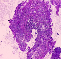 Ileo-cecal ulcer (biopsy): Chronic nonspecific ileitis with ulcer. Section show ileal mucosa, dense...