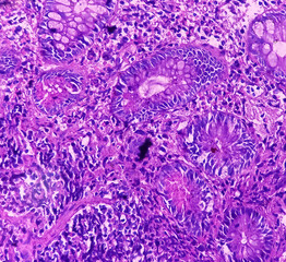 Ileo-cecal ulcer (biopsy): Chronic nonspecific ileitis with ulcer. Section show ileal mucosa, dense...