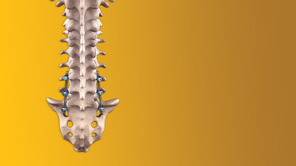Posterior Thoracic Fusion with Pedicle Screws and Rods on Yellow Background