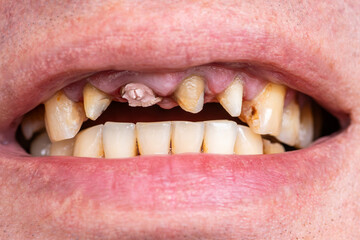 Periodontal disease, loose teeth in toothless man mouth, close up. Dental problems and orthodontic...