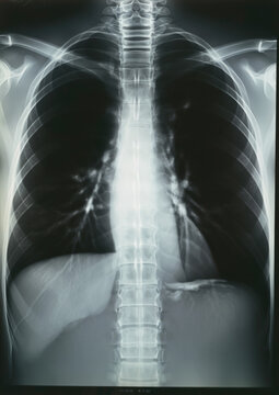 human chest x-ray, lungs, ribs, bones, medicine, treatment, hospital, fracture, clinic
