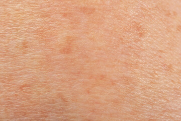 Texture of skin with pigmentation as background, macro view