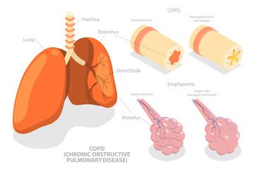 3D Isometric Flat  Conceptual Illustration of COPD, Chronic Obstructive Pulmonary Disease