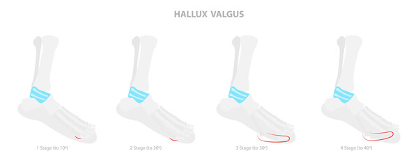 3D Isometric Flat  Conceptual Illustration of Hallux Valgus, Bunion in Foot - obrazy, fototapety, plakaty