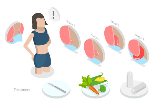 3D Isometric Flat  Conceptual Illustration of Hemorrhoids, Swollen Veins in Lower Rectum