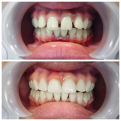 Before and after fixation for huge gap between front teeth or incisors, diastema.