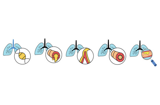 Bronchoskopie Bilder Durchsuchen 536 Archivfotos, und