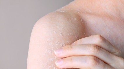 Skin is peeling shoulder with peeling skin close-up front view skin problems dry skin consequences of dehydration and dermatitis self care, concept of body and cosmetology hygiene and medicine