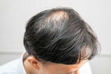 Fototapeta premium Bald in the middle head and begin no loss hair glabrous of mature Asian business smart active office man.