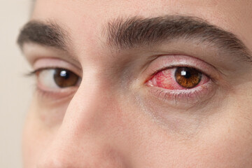Close Up of Severe Bloodshot Red Blood Eye of Male Affected by Conjunctivitis or After Allergy. Man...