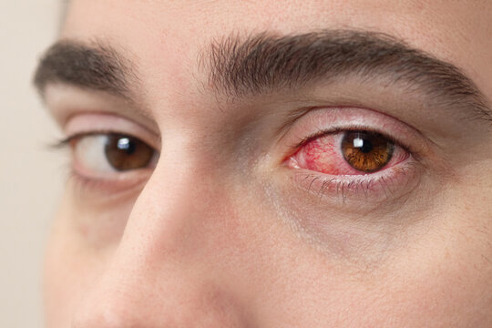 Close Up of Severe Bloodshot Red Blood Eye of Male Affected by Conjunctivitis or After Allergy. Man with Viral Blepharitis, Conjunctivitis, Adenoviruses.
