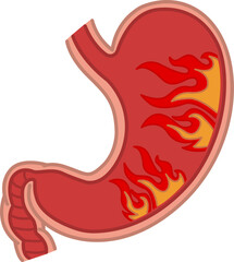 Gastritis of the stomach. Heartburn concept. Vector Illustration of a Human Stomach on Fire. Anatomy and Medicine
