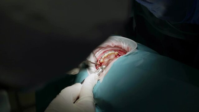 Professional doctors performing dental surgery, treating teeth in the patient's mouth.
