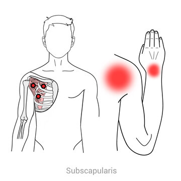 Subscapularis: Myofascial trigger points and associated pain locations