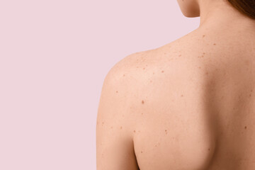Young woman with moles on pink background, back view