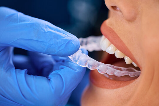 Close up of woman getting dental aligner at dentist's office.