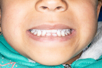 Frontal view of a young girl biting teeth with lips open. Milk teeth and permanent incisors with a skeletal Class III malocclusion, anterior crossbite because of retruded maxilla or protruded mandible © MSC