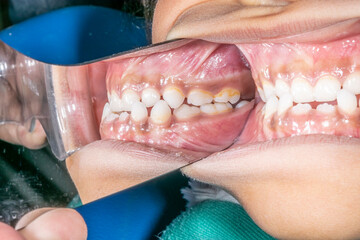 Dentistry clinical case of a biting child with class III orthodontic malocclusion, side view of mandibular and maxillary arches biting teeth indirect mirror view reflected © MSC