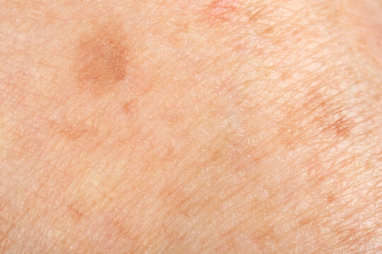 Texture of skin with pigmentation as background, macro view