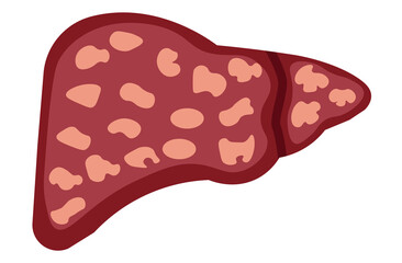 liver, cirrhosis disease. Human liver organ anatomy vector illustration on white background.Stage Of liver Disease Concept,Unhealthy Liver,Cirrhosis Medical Education,sad,red,yellow