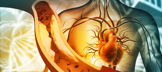Human heart with Clogged arteries on scientific background. 3d illustration. - obrazy, fototapety, plakaty