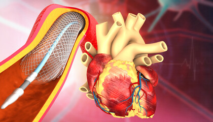 Human heart with angioplasty, stent implant. 3d illustration.