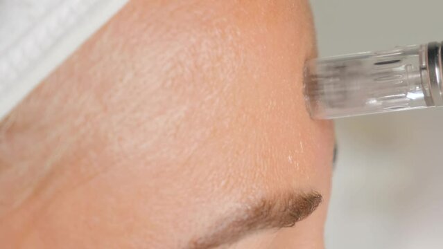 Close-up portrait of a beautiful aged woman during microneedling with dermapen from a beautician. Vertical video.